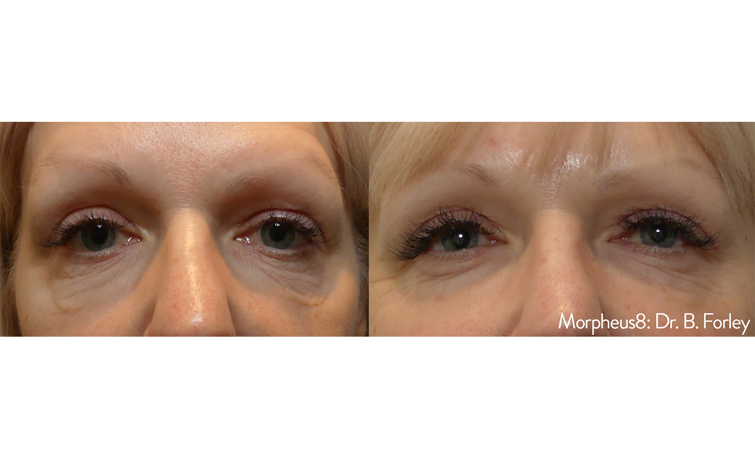 morpheus8-before-after-dr-b-forley-view
