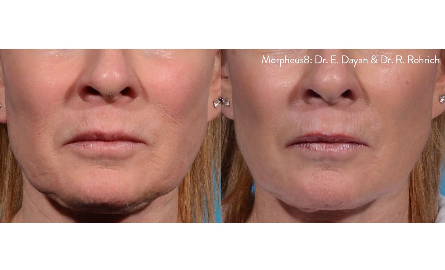 morpheus8-before-after-dr-rohrich and dr. e. dayan-preview-1